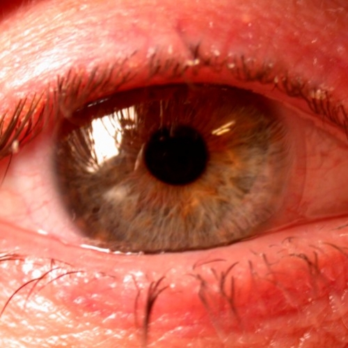 Cuidados com os olhos durante o verão